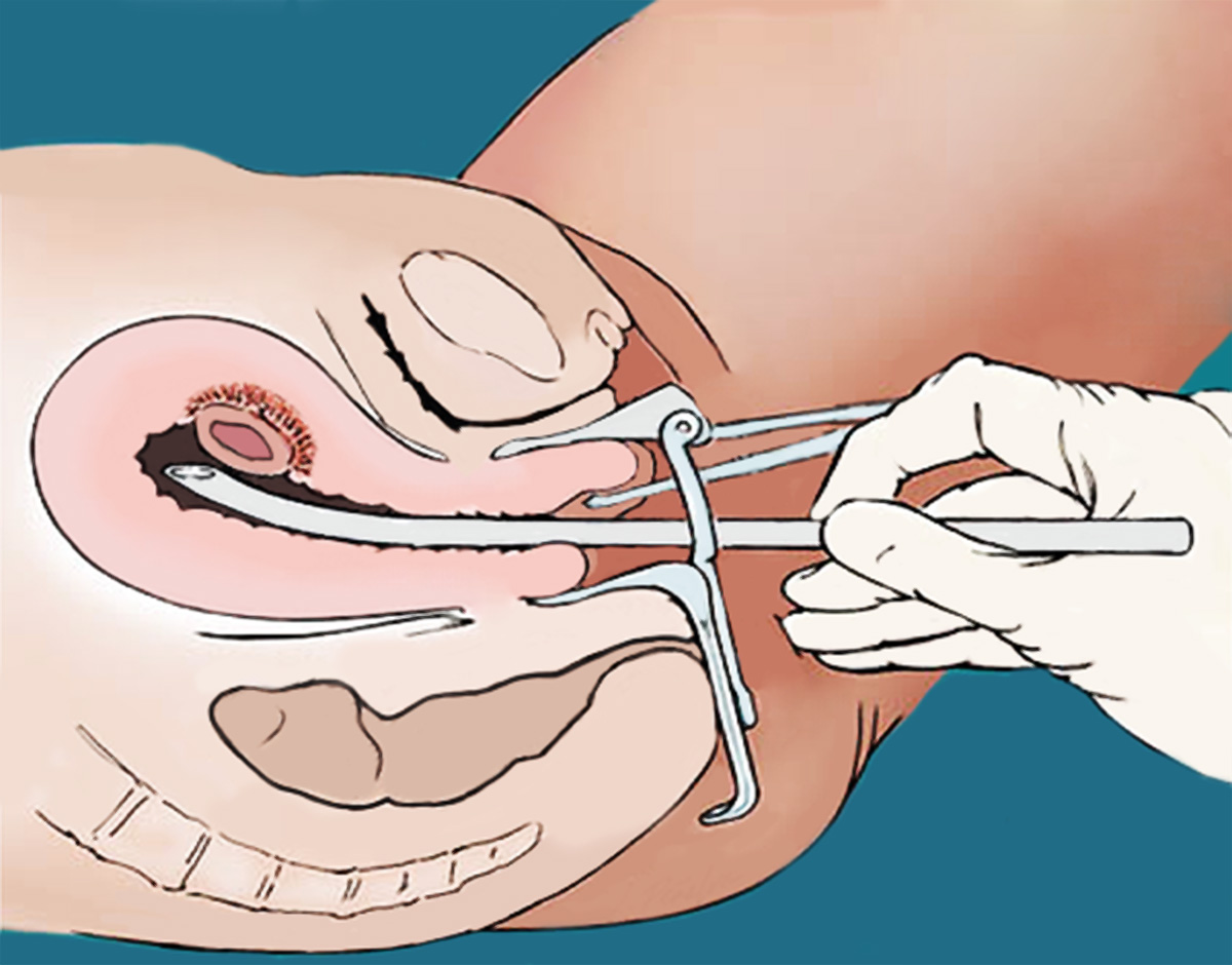 Aborto quirúrgico (Ilustración)
