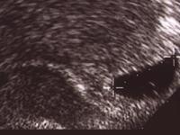 Gestational sac at 6 weeks gestation seen by ultrasound